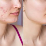 Acne Face Wash